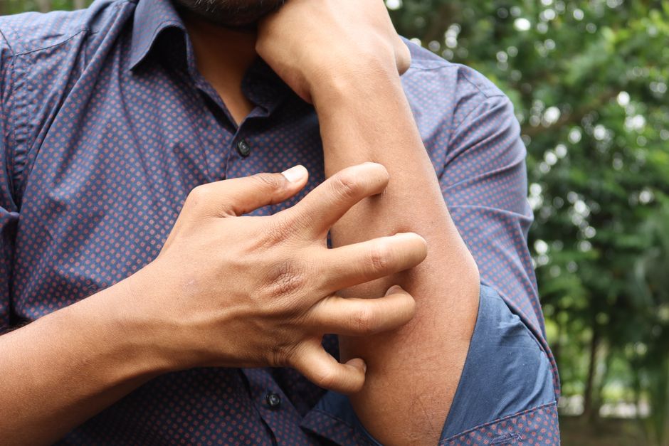 Why We Itch
